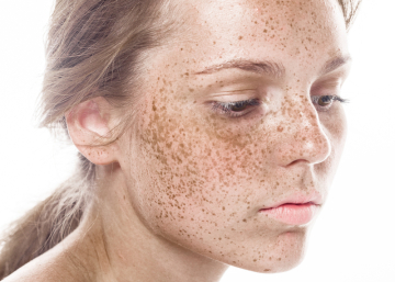 Praca z przebarwieniami skórnymi w gabinecie kosmetologa EmiSkin w Oleśnicy